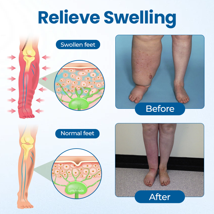 Mayo Clinic recommends👨⚕️: Lymphora Swelling Relief Roll-On