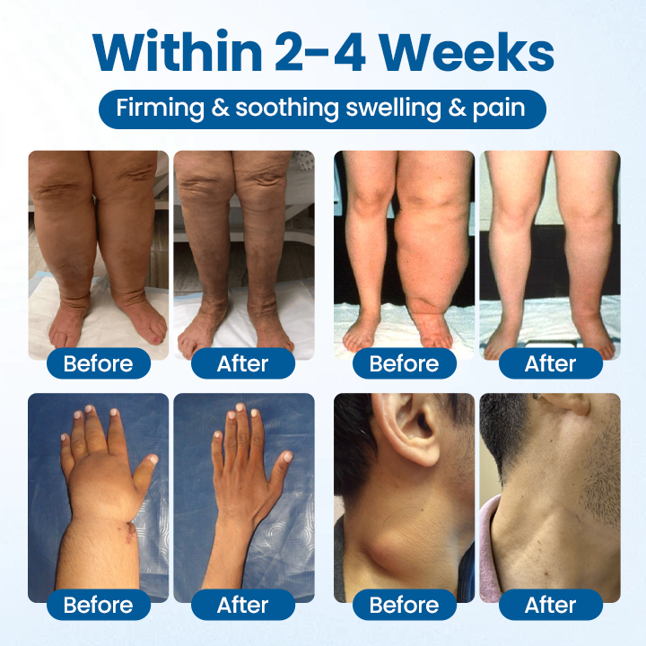 Mayo Clinic recommends👨⚕️: Lymphora Swelling Relief Roll-On